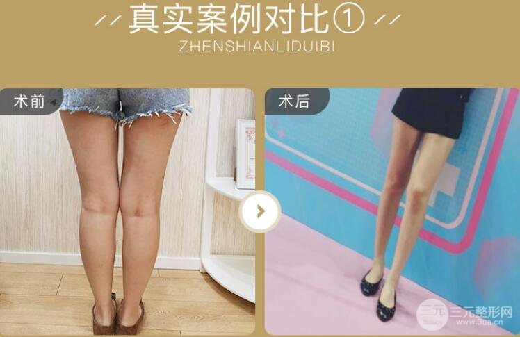 注射瘦臉瘦腿果圖