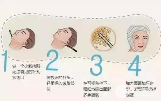 面部吸脂恢復(fù)期