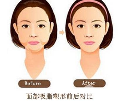 面部吸脂的好處