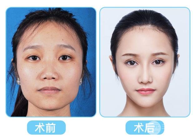 面部吸脂的危害