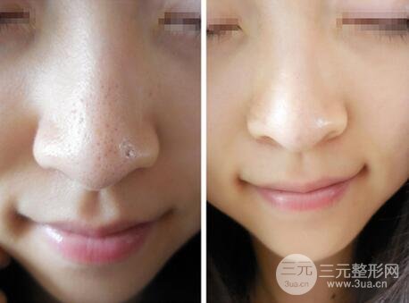 [美膚攻略]黑臉娃娃費用和果