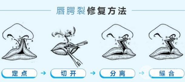 科普：兔唇手術(shù)多少錢？