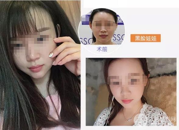 做黑臉娃娃后的注意事項(xiàng)