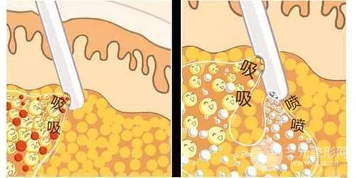 面部吸脂整形多久恢復自然？科普一下吧~