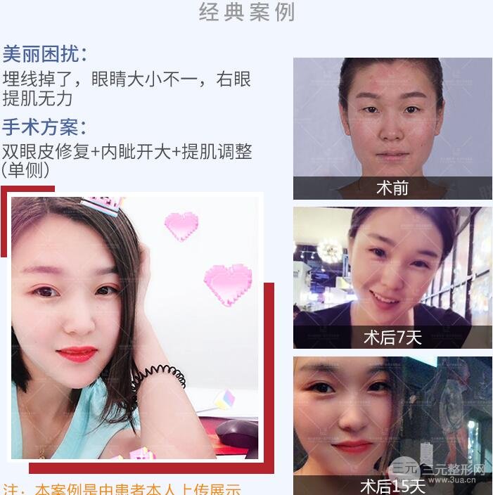 雙眼皮修復(fù)案例