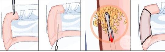 抽脂以后注意事項