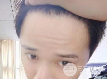 西京醫(yī)院植發(fā)價(jià)目表2020