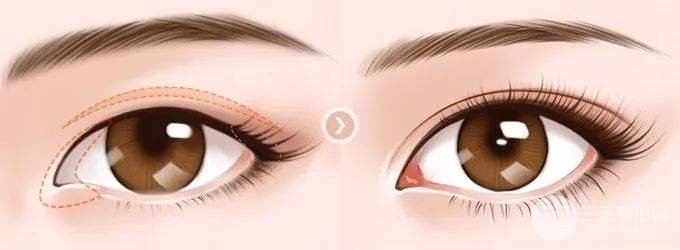 #術(shù)前攻略#韓式開內(nèi)眼角多少錢？看完心里就有數(shù)了~