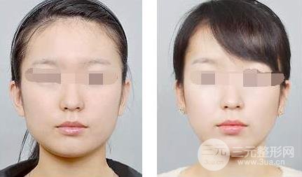 一針改寫命運(yùn)，10分鐘打造精致小臉，注射瘦臉價(jià)格奉上~