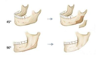 磨骨瘦臉疼不疼?