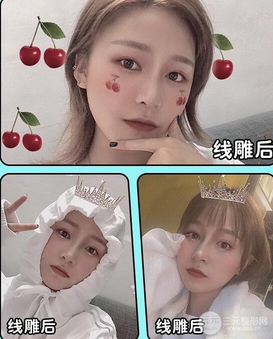 雷達(dá)埋線除皺果圖