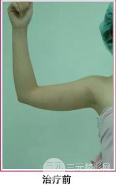 胳膊吸脂價格影響因素