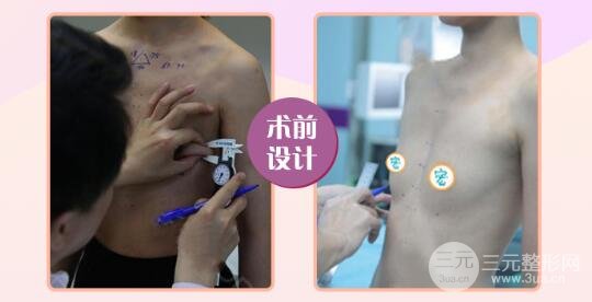 美國(guó)曼托妙桃娜綺麗、娜高等隆胸假體哪個(gè)好?