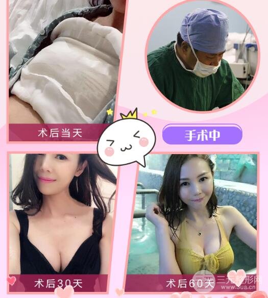 美國(guó)曼托妙桃娜綺麗、娜高等隆胸假體哪個(gè)好?