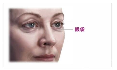 [眼袋走開]內(nèi)路去眼袋能保持幾年？多久能恢復(fù)自然呢？