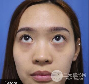 內(nèi)路去眼袋后的果