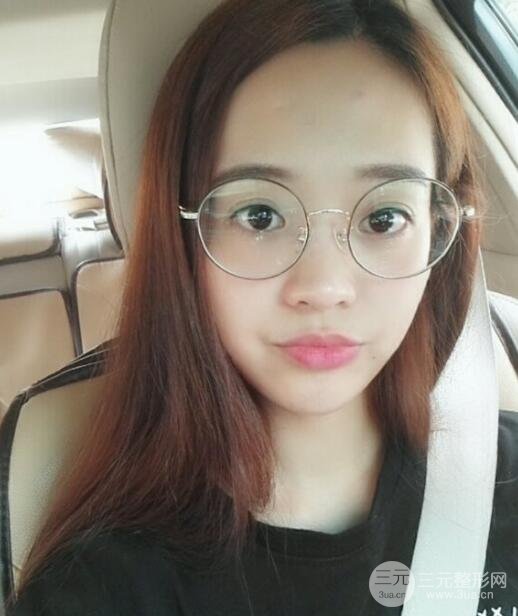 內(nèi)路去眼袋后的果