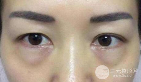 內(nèi)路去眼袋后注意事項(xiàng)