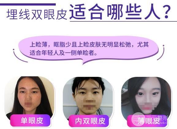 埋線重瞼術為啥會“掉”？