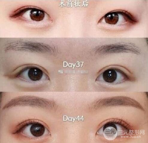 埋線重瞼術為啥會“掉”？