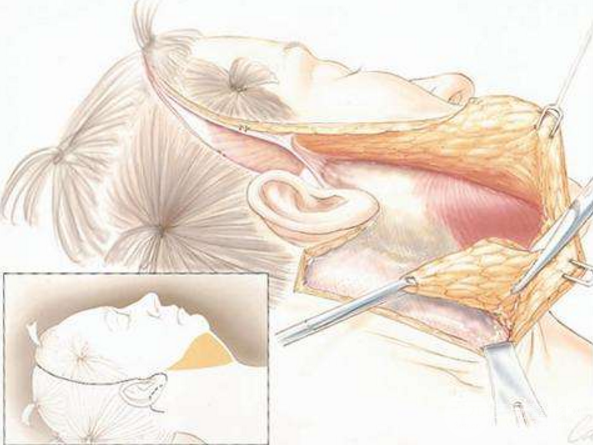 拉皮手術一般多少錢