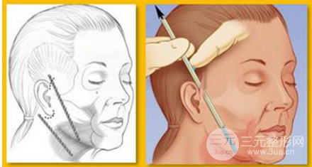 拉皮手術一般多少錢