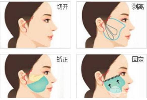 拉皮手術一般多少錢