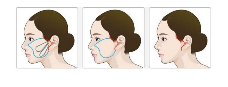 韓國(guó)面部除皺手術(shù)火到爆，帶你了解一下這個(gè)抗衰手術(shù)~