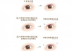 心血來潮介紹一下：微創(chuàng)雙眼皮手術(shù) 真的微創(chuàng)嗎？