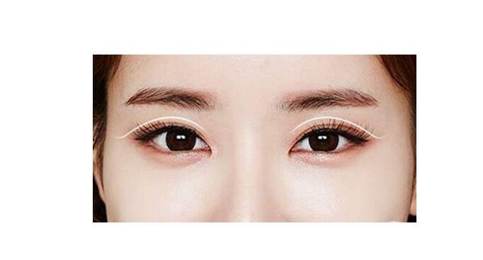 心血來(lái)潮介紹一下：微創(chuàng)雙眼皮手術(shù)