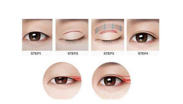 心血來(lái)潮介紹一下：微創(chuàng)雙眼皮手術(shù)