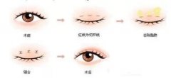韓式微創(chuàng)雙眼皮多少錢？韓式微創(chuàng)雙眼皮注意事項(xiàng)！