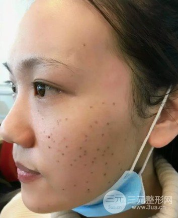 彩光去雀斑需要做幾次