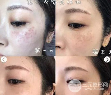 彩光去雀斑需要做幾次