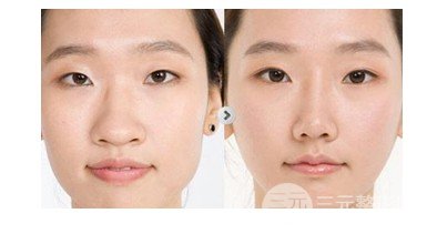 鼻翼肥大整形多少錢