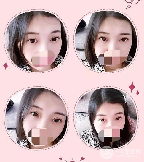 新星靚劉風卓眼修復(fù)