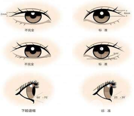 微創(chuàng)雙眼皮多少錢