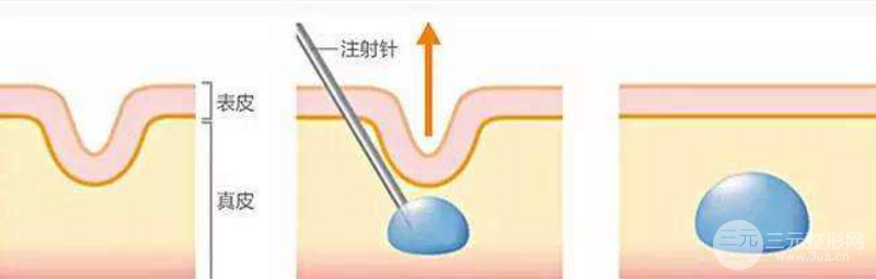 臉部哪些部位可以注射膠原蛋白美容