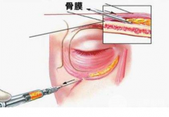 玻尿酸填淚溝隔多久打一次？填平你的“美麗代溝”