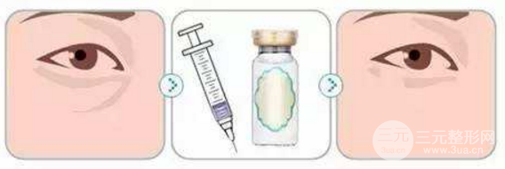 玻尿酸填淚溝隔多久打一次？