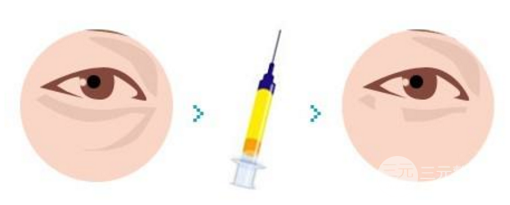 玻尿酸填淚溝隔多久打一次？