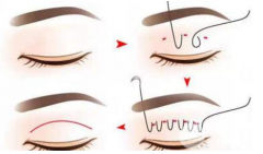 雙眼皮埋線價(jià)格揭秘，看完果然“真香”
