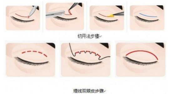 雙眼皮埋線價(jià)格