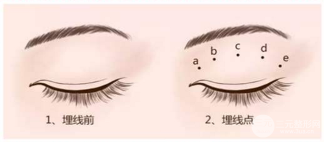 雙眼皮埋線價(jià)格