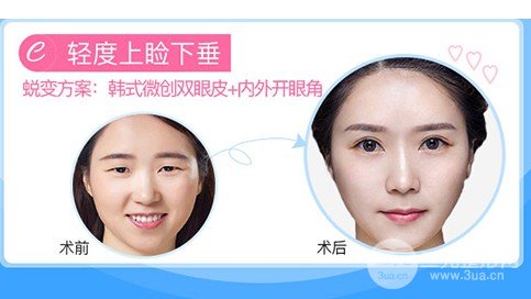 微創(chuàng)雙眼皮手術(shù)恢復全程