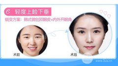 韓式微創(chuàng)雙眼皮恢復(fù)圖記錄，“隱形”果超好!