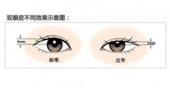 雙眼皮手術(shù)修復(fù)醫(yī)院選擇，同院還是換一家?