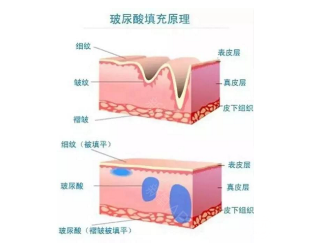 公主玻尿酸屬于什么類型的玻尿酸？