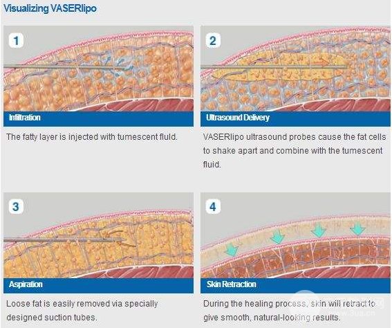 運(yùn)動(dòng)沒果？減腿抽脂手術(shù)看看感不感興趣
