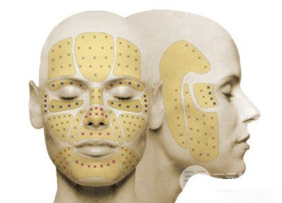 雙美膠原蛋白可以填充哪些部位